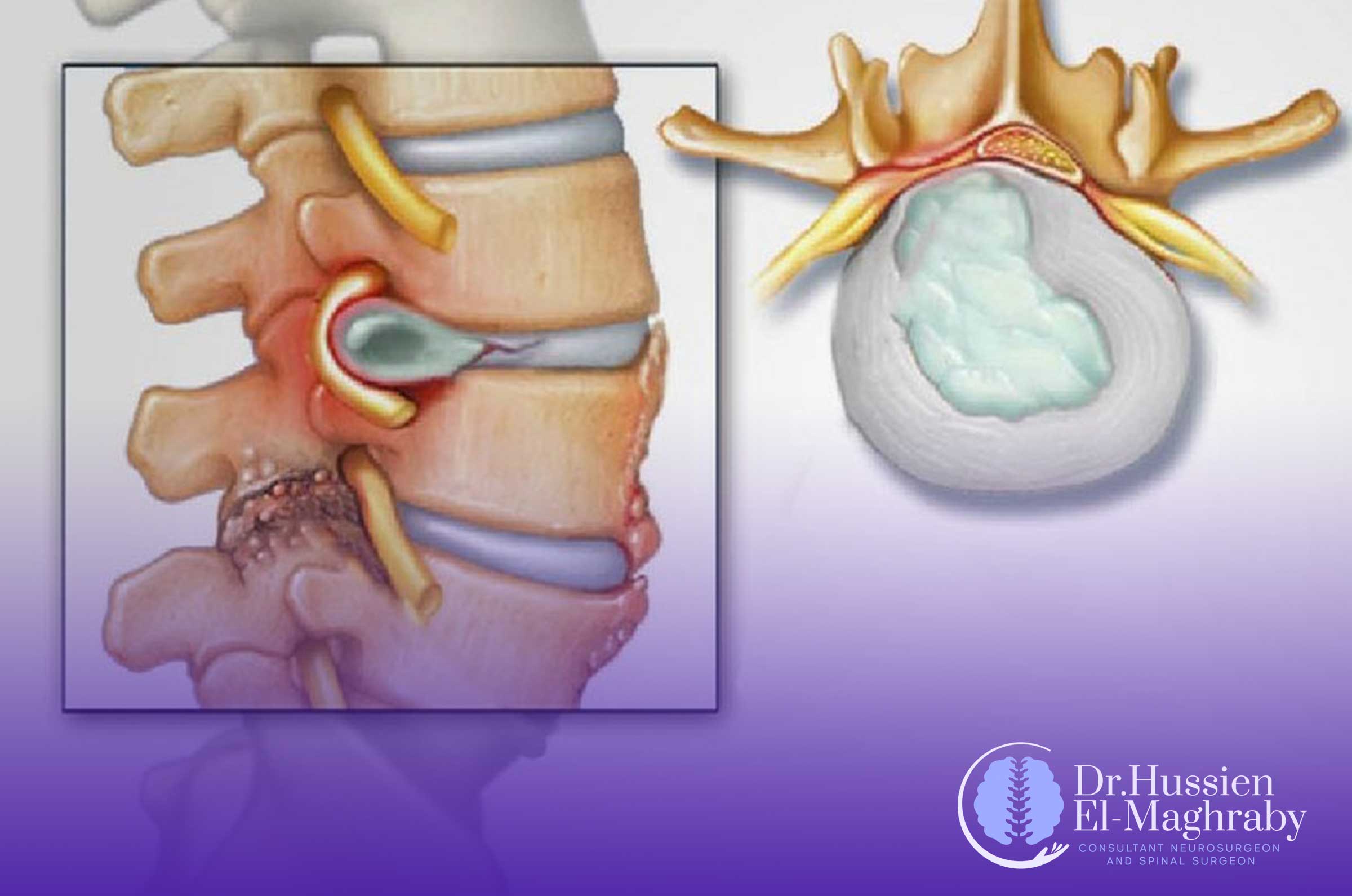 Challenges-of-Spinal-Stenosis-and-Coping-Strategies