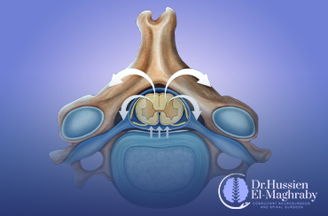 Decompression-of-Spinal-Canal-using-3D-Printing-and-Artificial-Intelligence