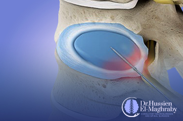 Percutaneous-Laser-Disc-Decompression