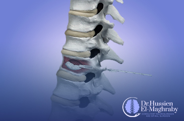 Vertebral-Cement-Injection